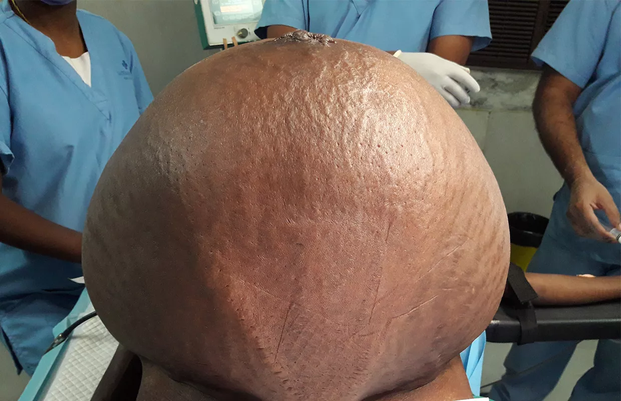 HEAVIEST ABDOMINAL TUMOUR REMOVED THROUGH SURGERY